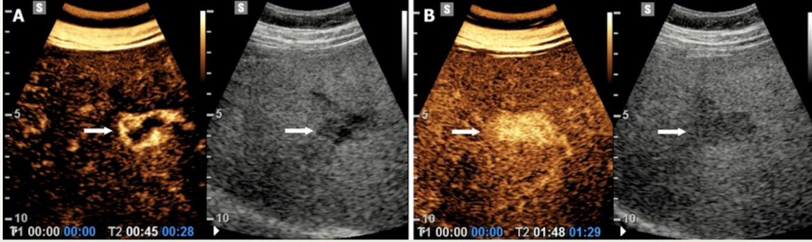 <p>what lesion is seen on this CEU?</p>