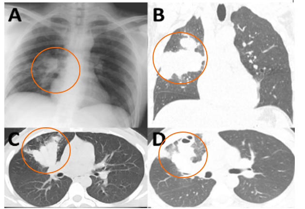 <p><span>Malignant mass in lung</span></p>