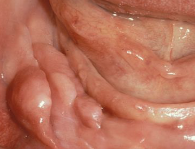 <p>Why might relining be necessary?</p>