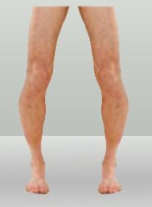 <p>condition that gives bowed legs due to vitamin-d deficiency</p>