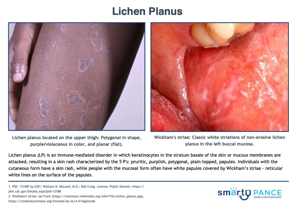 <p>Chronic inflammatory skin condition characterized by purple, pruritic, polygonal, planar, papules, and plaques that appear on the wrists, ankles, lower back, genitalia, and mouth. </p><p>-Associated with hepatitis C infection</p><p>-Dx: clinical, confirm with skin biopsy </p><p>-Tx: high potency topical corticosteroids </p>