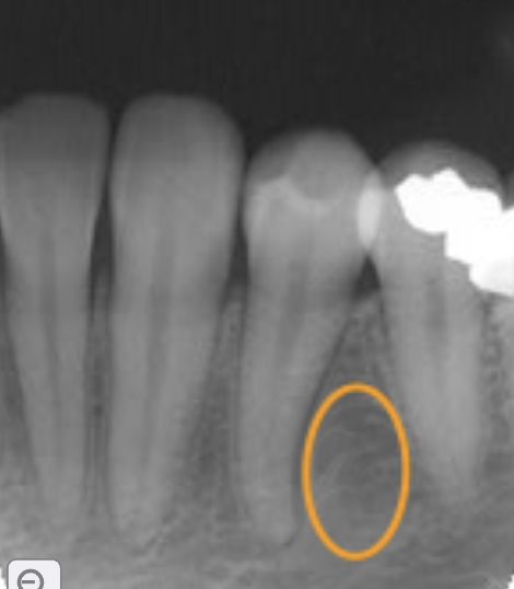 <p>alveolar bone</p>