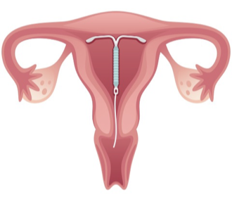 <p><strong>Levonorgestrel IUD -</strong> common progestin in IUDs</p><ul><li><p>Releases progestin regularly, providing steady hormone level</p></li></ul><p><strong>Mechanism/Onset of Action</strong></p><ul><li><p>Foreign body at uterus prevents fertilization, impairs sperm transport</p></li><li><p>Slow release of levonorgestrel causes thickening of cervical mucus, antiproliferative effect on endometrium and suppression of ovulation</p></li></ul><p><strong>Therapeutic Regimen</strong></p><ul><li><p>Inserted by a trained clinician and replacement depends on product expiry (3 vs. 5 years)</p></li></ul><p></p>