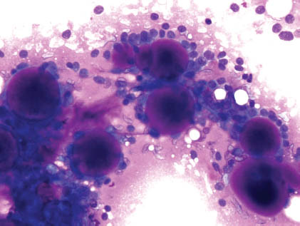 <p>Tumeur des glandes salivaires </p><p>1) Diagnostic</p><p>2) aspect typique</p>