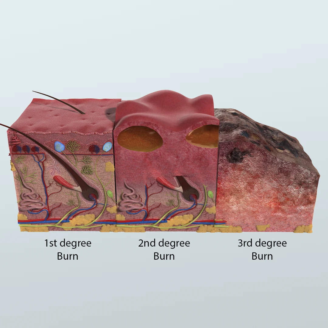 <p>Classification of Burns</p>