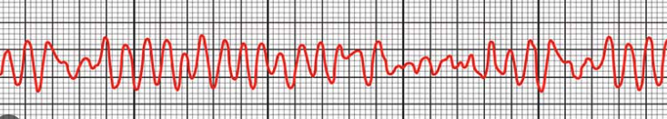 <p>rapid irregular waveforms with no P, QRS, T waves</p>