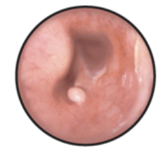 <p>Abnormal bone growth within ear due to chronic irritation, heredity, or unknown reasons</p>