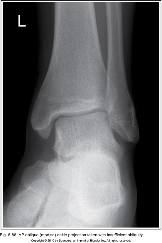 <p>AP ankle oblique (mortise)</p>