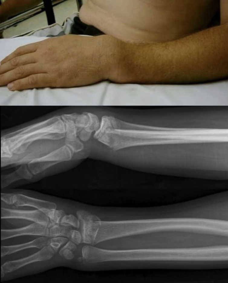 <p>forearm fractures treatment</p>