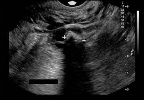 <p>A 26 yr old female presents with pelvic pain and prior left oophorectomy due to cyst formation. Which of the following best describes the findings on the image?</p><p>A. The calipers are measuring a large echogenic mass with dirty shadowing which most likely represents a large fecalith in the bowel.</p><p>B. The calipers are measuring a large echogenic mass with dirty shadowing which most likely represents an obstruction in the bowel.</p><p>C. The calipers are measuring a large echogenic mass with posterior shadowing which most likely represents a dermoid cyst.</p><p>D. The calipers are measuring a large echogenic mass with posterior shadowing which most likely represents a chocolate cyst.</p>