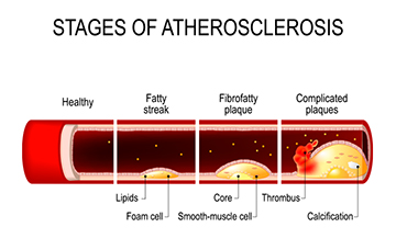 <p><span style="background-color: transparent; font-family: "Times New Roman", serif;"><strong>Fatty Streak:</strong> The earliest visible sign; flat yellow dots made of <strong>Foam Cells</strong> (macrophages that ate LDL).</span></p>
