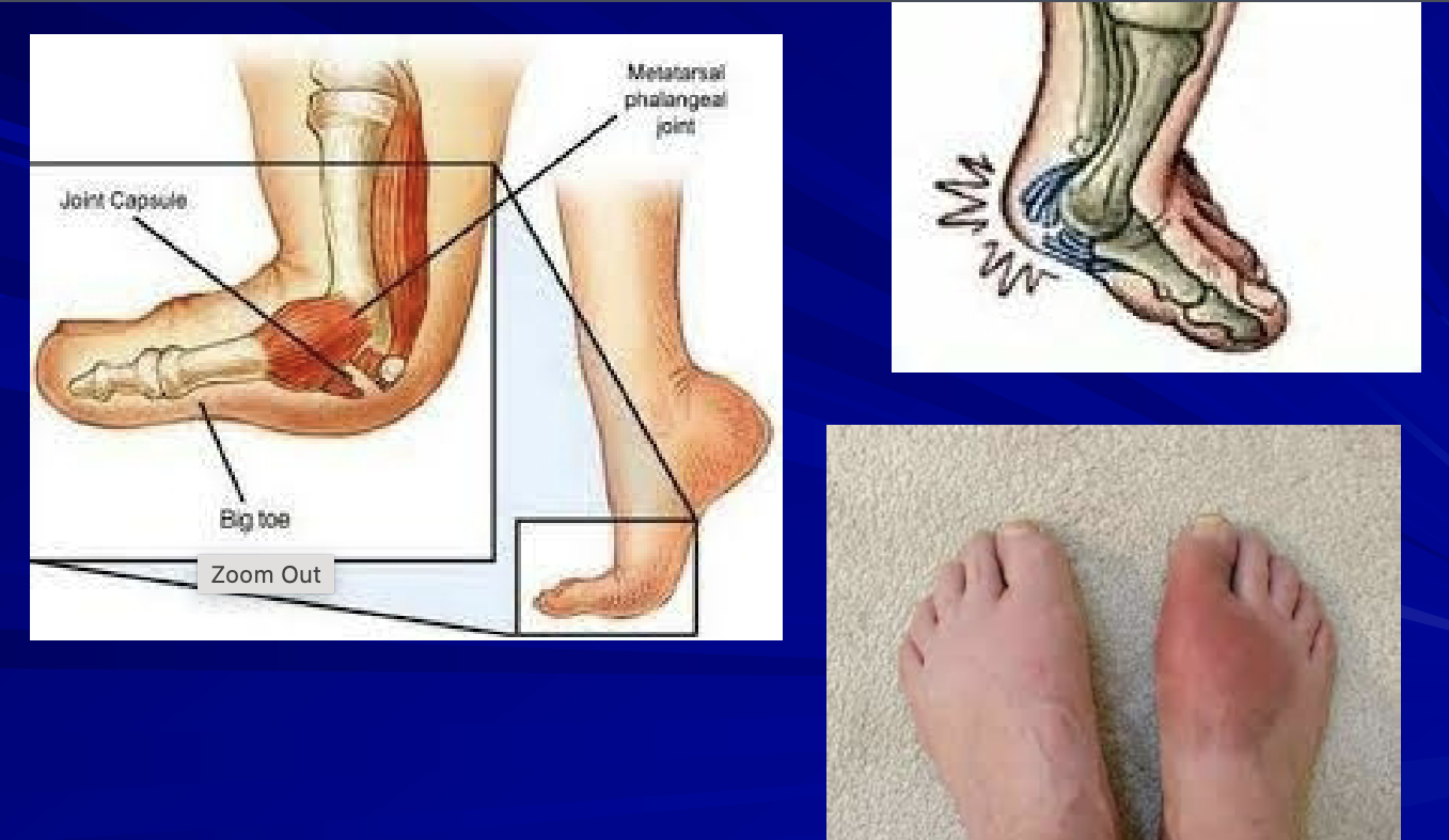 <p>What is “turf toe”? MOI?</p>