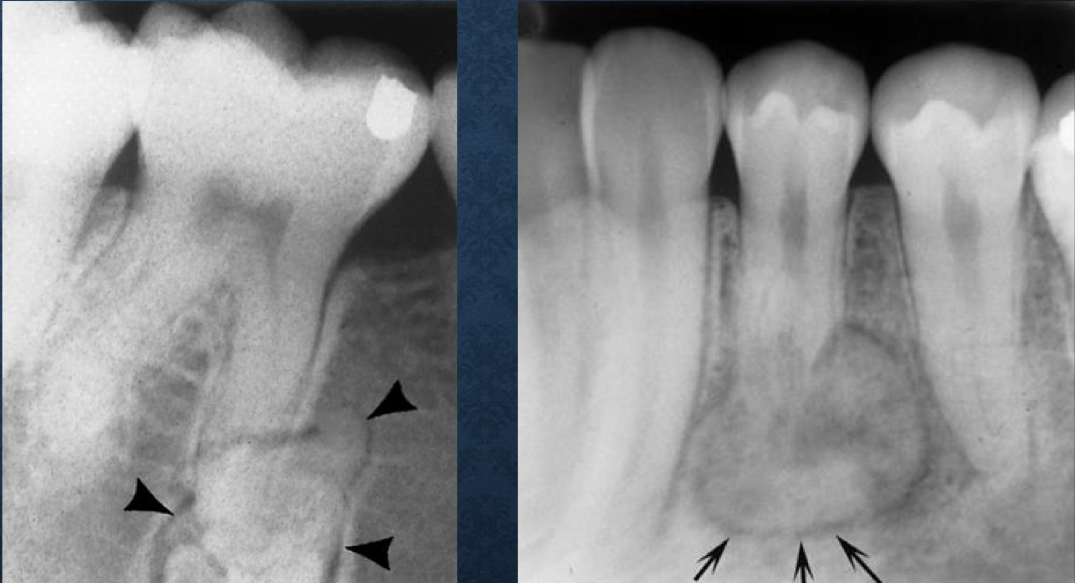 <p>radiolucent at the periphery</p><p>usually indicates a benign tumor</p>