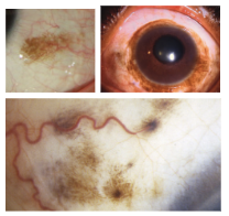 <p>What is the most likely diagnosis ?</p>
