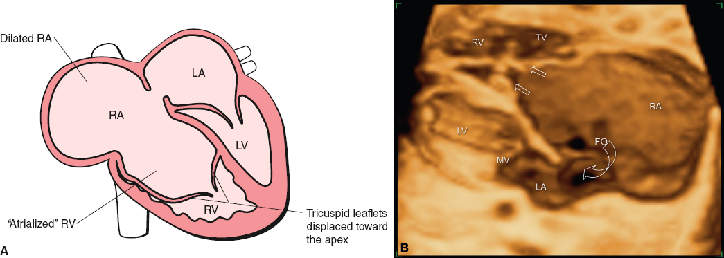 <p>Malpositioned tricuspid valve</p><p>Right and left atrial shunting</p><p>Tricuspid regurgitation</p><p>Enlarged right atrium</p><p>Deviation of the atrial septum to the left</p><p>Fetal hydrops (secondary to cardiac failure)</p>