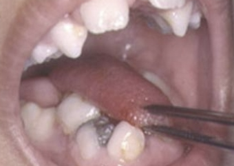 <p>abnormally small tongue </p>