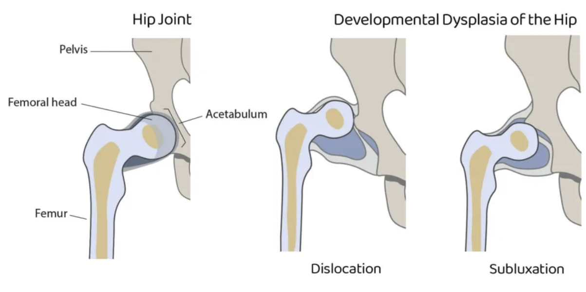 <p>A condition where the hip joint is improperly formed, causing the femoral head to be unstable, partially dislocated, or fully dislocated from the acetabulum </p>