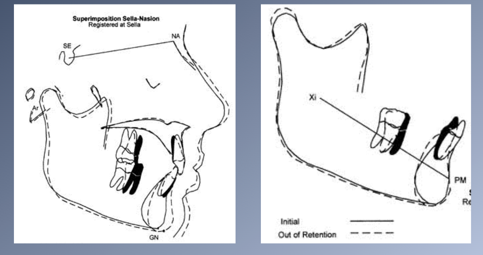 <p><span>1. Mandible undergoes more growth in the late teens than the maxilla.</span><br><span>2. Can late mandibular growth cause late mandibular incisor crowding?</span></p><p><span>3. The position of the dentition relative to the jaws is influenced by their pattern of growth.</span><br><span>4. Mandible grows forward relative to the maxilla in the late teens</span></p><p><span>5. Patients with tight anterior occlusion before mandibular growth</span><br><span>6. Contact relationship of the lower and the upper incisors must change if the mandible grows forward.</span><br><span>1. Mandible is displaced distally à distortion of the TMJ and displacement of the articular disc.</span><br><span>2. Upper incisors flare forward, opening space between these teeth.</span><br><span>3. Lower incisors displace distally and become crowded.</span></p>