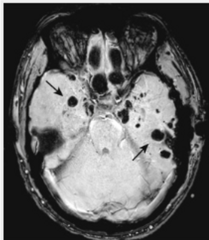<p>punctuate hemorrhages (dark spots)</p>