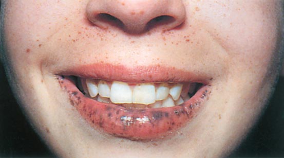 <p>peutz-jehgers syndrome definition</p>