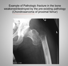 <p>Pathologic Fracture</p>
