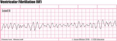 <p>ECG Patterns: VF</p>