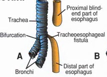 <p>The trachea and the esophagus start forming as 1 tube. At 4 to 8 weeks of pregnancy, a wall forms between the esophagus and trachea. This separates them into 2 tubes. TE fistula and esophageal atresia happen when this wall doesn't form as it should. Usually sporadic but also associated with aneuploidy and VACTERL</p>