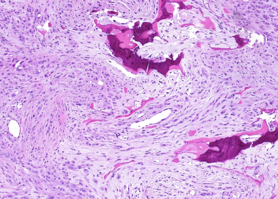 <p>Tumeur du fémur homme jeune</p><p>diagnostic</p><p>définition</p><p>age</p><p>topographie</p><p>anatomie</p><p>histologie</p><p>IHC moléculaire</p><p>DD</p>