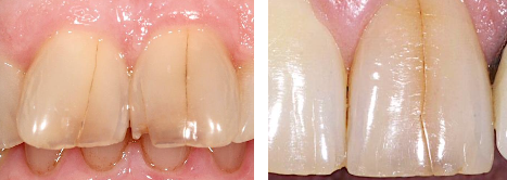 <p><strong>aka:</strong> crack</p><p>normally limited to the <span style="color: rgb(255, 0, 0);">enamel </span>(ex: enamel infraction) and usually stop before reaching the dentinoenamel junction</p><ul><li><p><strong>tx:</strong></p><ul><li><p>periodic follow-up examinations</p></li><li><p><span style="color: red;">sealed with unfilled resin</span></p></li></ul></li></ul><p></p>