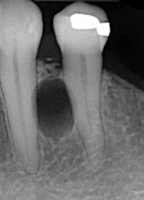 <p>which of the following is NOT in the differential </p><p>periapical cyst </p><p>lateral periodontal cyst </p><p>odontogenic keratocyst </p><p>ameloblastoma </p>