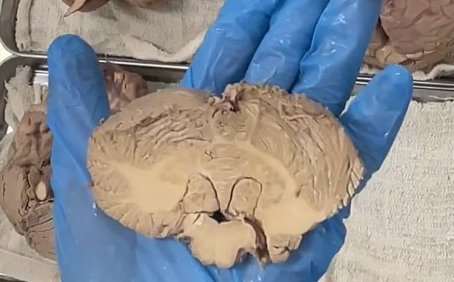 <p>horizontal section of the cerebellum at the level of the rostral medulla. </p>