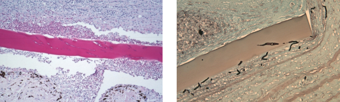 <ul><li><p>involvement of posterior 1/3 of cornea</p></li><li><p>fungal hyphae found within descemet’s membrane (attracted to carbohydrates) & deep corneal stroma; rarely extend into anterior chamber</p></li><li><p>breaks in descemet’s membrane with pyogranulomatous inflammation; occasional multinucleated giant cells</p></li><li><p>often very little corneal neovascularization</p></li></ul><p></p>