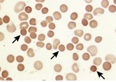 <p>Variants in genes that encode proteins of the red blood cell (RBC) membrane and cytoskeleton leading to sphrerocytic TBC shape</p>