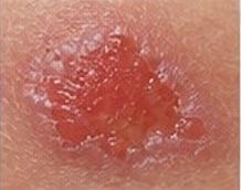 <p><span>Loss of part of the epidermis; depressed, moist, glistened area; follows the rupture of a vesicle or bulla (e.g., candidiasis).</span></p>