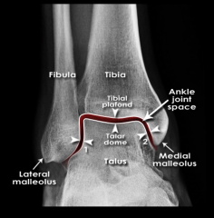 <p>Distal tibial joint surface, Forms the roof of the ankle mortise joint</p>