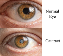 <p><span><strong>Opacity of the lens. </strong>Very common and a leading cause of blindness.</span></p><p style="text-align: left;"><span>Vision is loss because the opacification prevents light from focusing</span></p><p style="text-align: left;"><span>on the retina</span></p><p style="text-align: left;"></p><p style="text-align: left;"><span><strong>Several Types</strong></span></p><ul><li><p><strong>Nuclear cataract: </strong>the most common type of cataract, begins with a gradual hardening and yellowing of the <strong>central</strong> zone of the lens</p></li><li><p><span><strong>Cortical cataract: </strong>Opacity occurs on the <strong>sides</strong>. Patients may c/o glare in dim illumination</span></p></li><li><p><span><strong>Posterior subcapsular cataract: </strong>more rapid progression, occurs in younger patients</span></p></li><li><p><span>Cataracts can appear any age but aging is a risk factor for the most common form of cataract. Up to 20% of older adults are affected</span></p></li><li><p><span>Congenital cataracts (can be idopathic or related to infection or metabolic disease), traumatic cataracts, medication induced (e.g. corticosteroids). Diabetics, smokers at risk</span></p></li><li><p><span>Most common surgery in the U.S. is cataract surgery</span></p></li></ul><p></p><p><span><strong>ROS:</strong></span></p><ul><li><p><span>Non-painful</span></p></li><li><p><span>Progress over months to years</span></p></li><li><p><span>Difficulty with glare (example: headlights at night, sunlight)</span></p></li><li><p><span>Decreased night vision</span></p></li><li><p><span>Halos around lights</span></p></li><li><p><span>Blurred vision</span></p></li></ul><p></p><p style="text-align: left;"><span><strong>PE:</strong></span></p><ul><li><p><span>Color of lens is white to gray</span></p></li><li><p><span>Use direct ophthalmoscopy</span></p></li></ul><p></p>