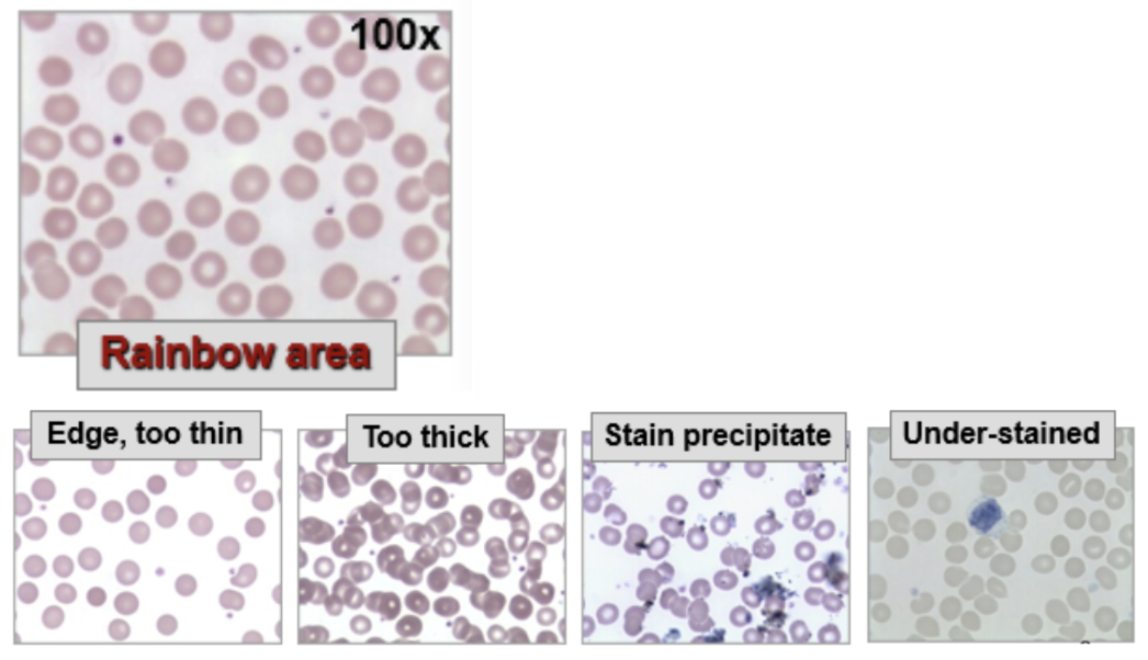 <ul><li><p><span style="background-color: transparent;">Manual differentials are done if significant patient abnormalities exist and/or automated differential results are flagged</span></p></li><li><p><span style="background-color: transparent;">Requires well-made stain/smear:</span></p></li></ul><ul><li><p><span style="background-color: transparent;">Oil immersion and high light</span></p></li><li><p><span style="background-color: transparent;">Rainbow are where red cells just touch, correct FOV ~150-200 RBCs</span></p></li></ul><p><span style="background-color: transparent;"><strong><u>Differentials include</u></strong>: </span></p><ul><li><p><span style="background-color: transparent;">WBC differential to classify WBC types</span></p></li><li><p><span style="background-color: transparent;">Slide is scanned from side-to-side, counting and identifying 100 consecutive WBCs = %</span></p></li></ul><p><span style="background-color: transparent;"><strong><u>Usual Differential Sequence</u></strong>: Seg neutrophils → Band neutrophils → Lymphocytes → Monocytes → Eosinophils → Basophils</span></p><ul><li><p><span style="background-color: transparent;">Cell Morphology/appearance</span></p></li></ul><ul><li><p><span style="background-color: transparent;">Evaluation of WBCs, RBCs, and platelets → 10 fields</span></p></li></ul><p><span style="background-color: transparent;"><strong><u>Platelet estimate</u></strong>: done to verify the accuracy of automated platelet counts</span></p><p></p>