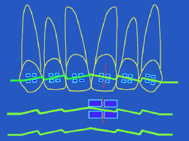 <p>2nd order bends</p>