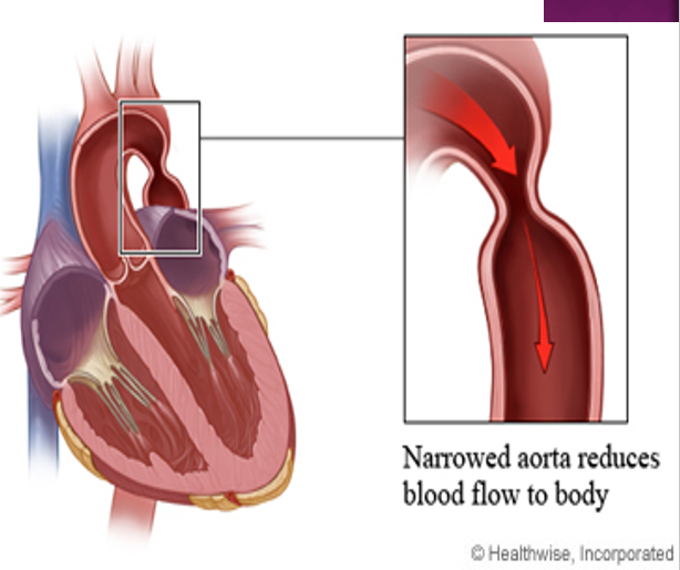<p>discrete narrowing or obstruction of the ao arch located in the descending ao</p><ul><li><p>usually in area of ao isthmus</p></li></ul><p></p>