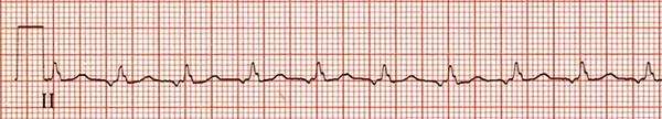 <p>Rate: >100</p><p>Regularity: irregular </p><p>P wave morphology is different </p>