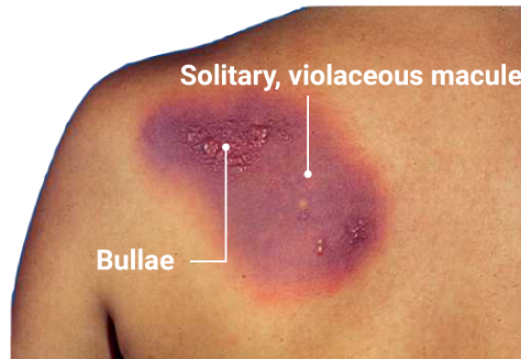 <p>causes of fixed drug eruption</p>