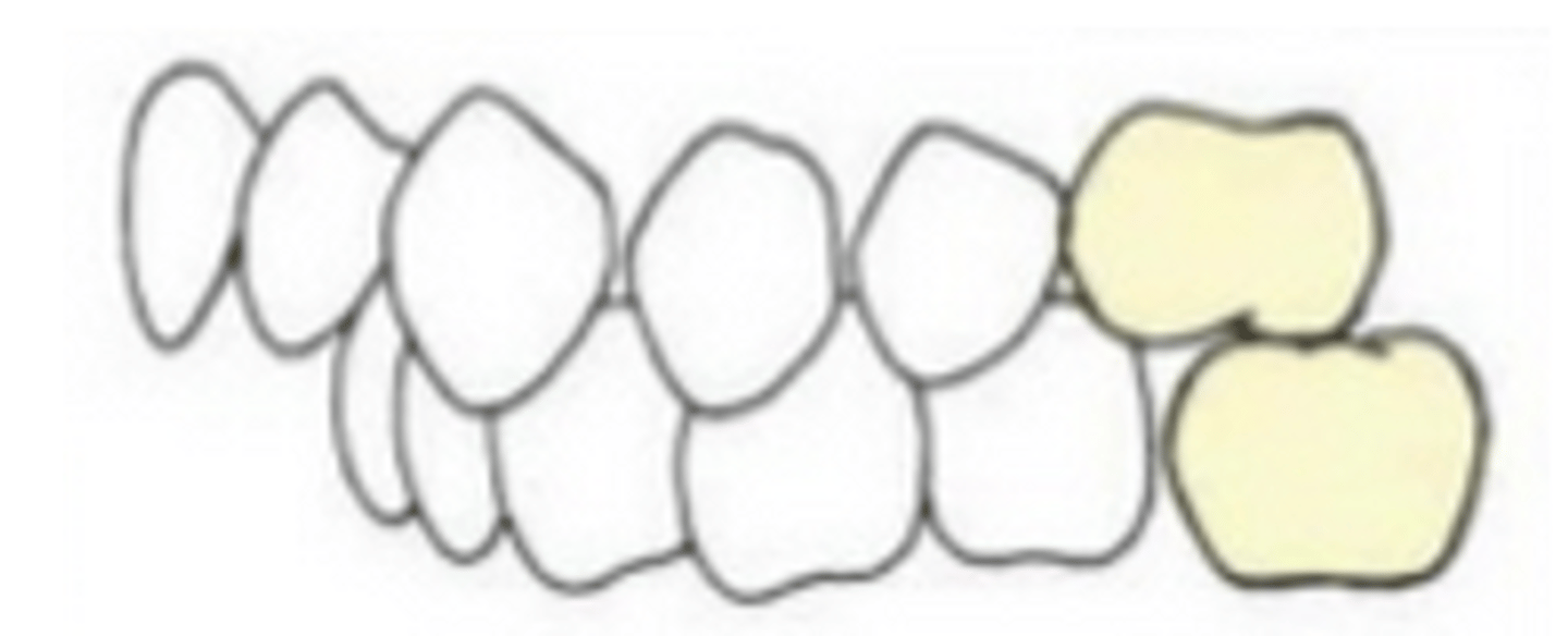<p>When the mandibular 1st molar is positioned further <strong>distal</strong> to the maxillary 1st molar</p>