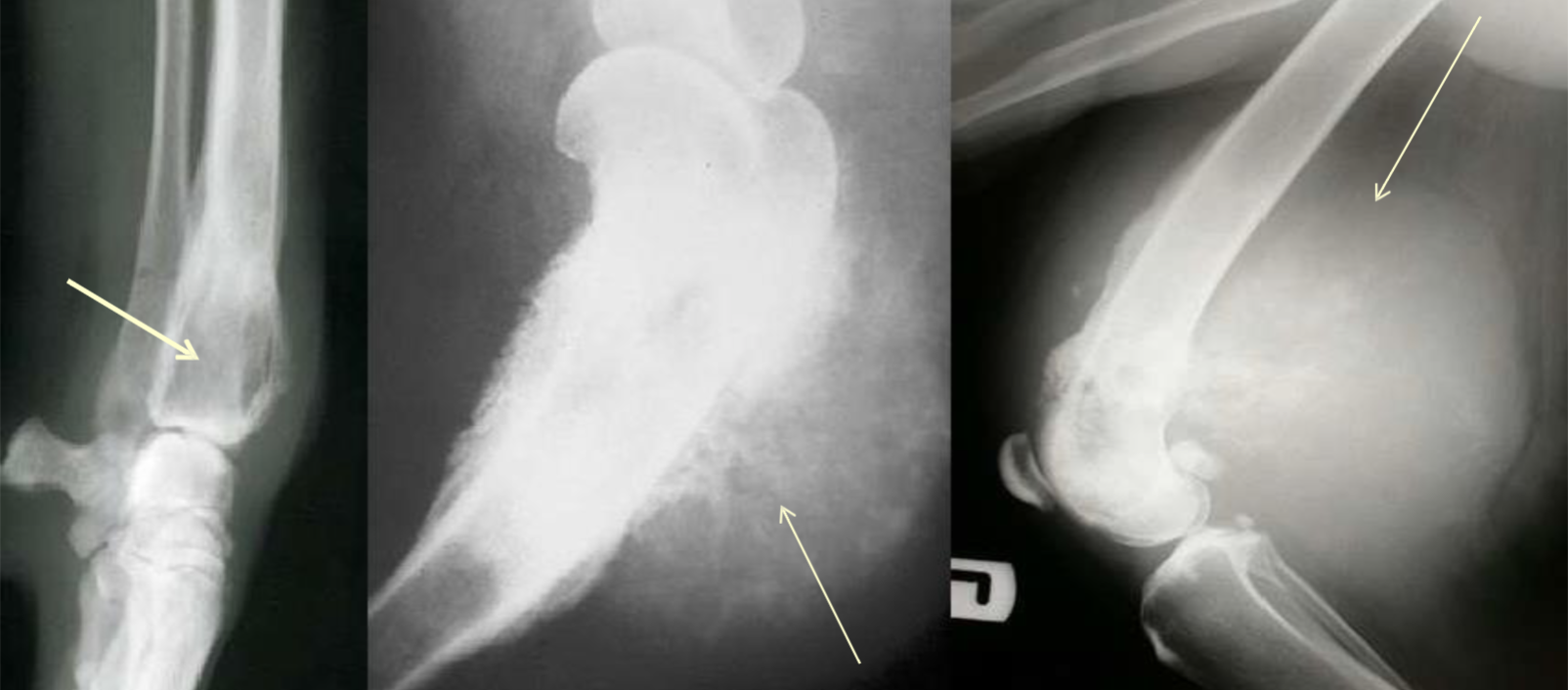 <p>name the three form of oseosarcomas from left to right </p>