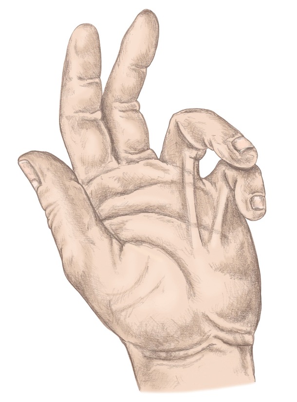<p>abnormal thickening of palmar aponeurosis </p><ul><li><p>causing contracture of small and ring fingers</p></li><li><p>(surgical procedure »fasciotomy)</p></li></ul><p></p>