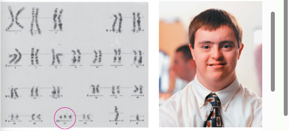 <p>Intellectual disability, flat facial profile and epicanthal folds; congenital heart defects, early development of Alzheimer's, increased risk of leukemia.</p>