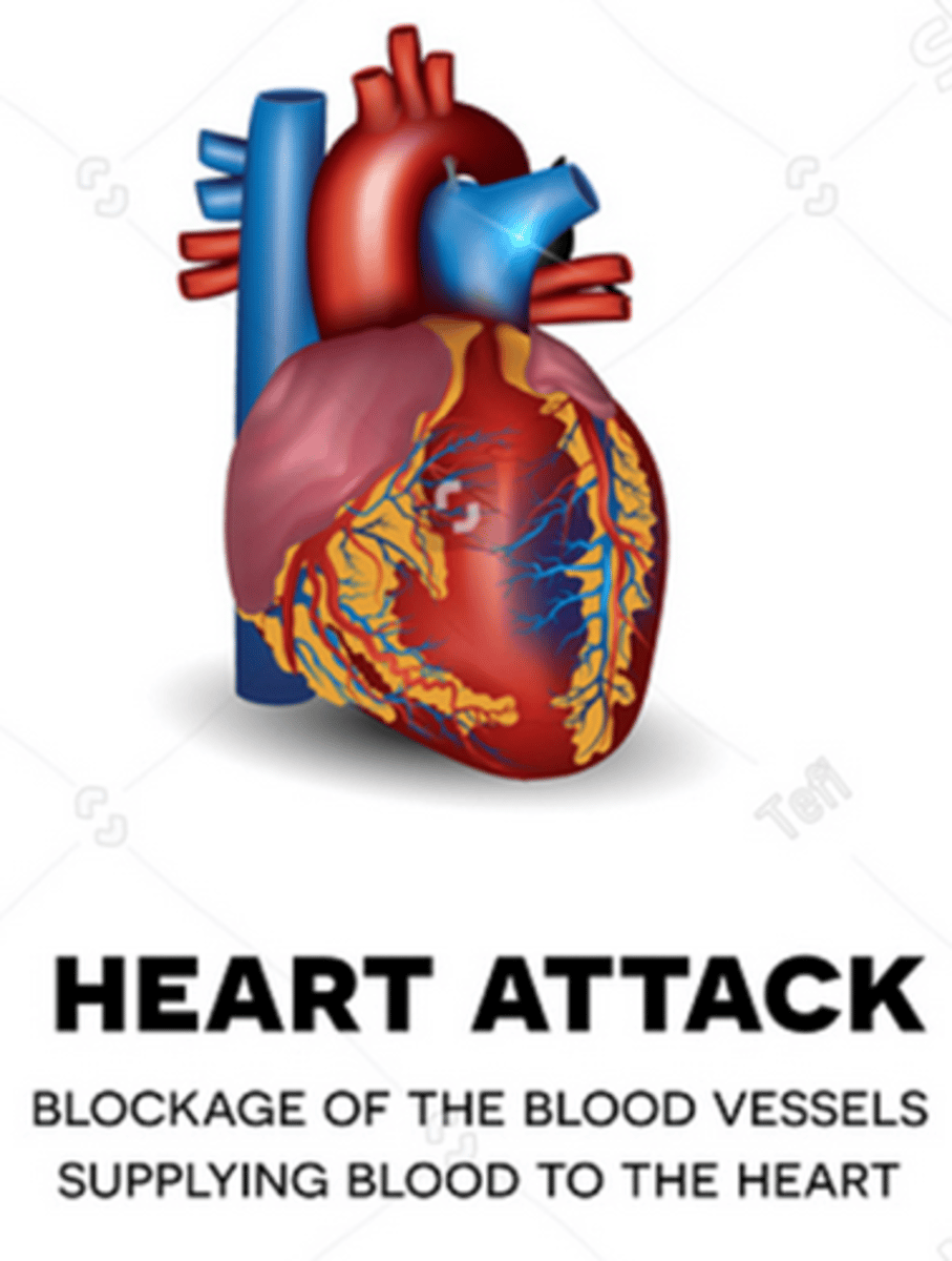 <p>B) Myocardial infarction is a total obstruction of the coronary artery, resulting in necrosis of the heart muscle cells caused by thrombus or vasospasm</p>