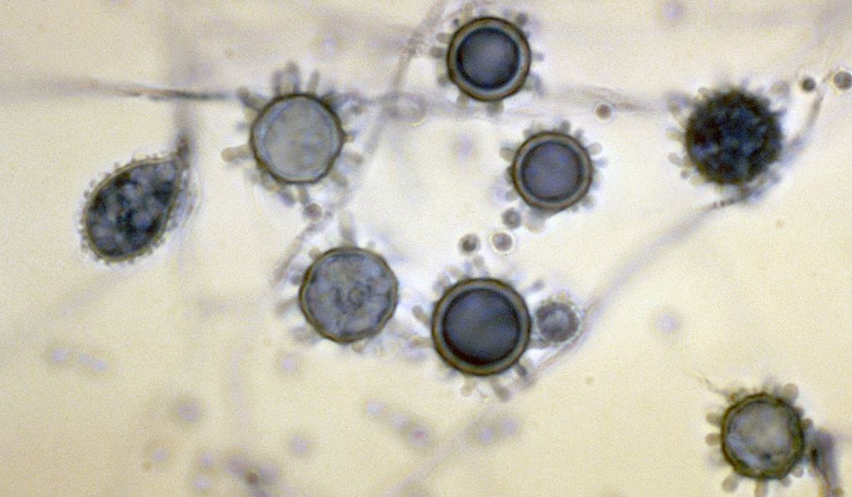 <p>Histoplasmosis</p>