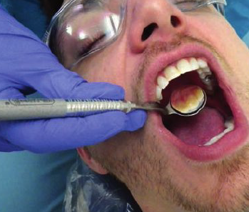 <ul><li><p>11 to 1 o’ clock position</p></li><li><p>Hold mirror in right hand, rest ring and pinkie on patient’s right cheek or incisal edges of maxillary anterior tooth</p></li><li><p>Mirror head is not held near maxillary anteriors, positioned closer to tongue</p></li><li><p>Swivel mirror head so surfaces away from you are seen</p></li></ul><p></p>