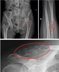 <p>What is this?</p><p>- >50 yo, Black male</p><p>- Pain</p><p>- Mandible, ilium, VB, ribs, prox femur, scapula</p>