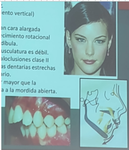 <ul><li><p><span style="background-color: transparent;">(dirección de crecimiento vertical)</span></p></li><li><p><span style="background-color: transparent;">Los sujetos presentan cara alargada estrecha, con un crecimiento rotacional posterior de la mandíbula</span></p></li><li><p><span style="background-color: transparent;">Generalmente su musculatura es débil</span></p></li><li><p><span style="background-color: transparent;">Suelen presentar maloclusiones clase II división 1 con arcadas dentarias estrechas y apiñamiento dentario</span></p></li><li><p><span style="background-color: transparent;">Altura facial anterior mayor que la posterior y tendencia a la mordida abierta</span></p></li></ul><p></p>